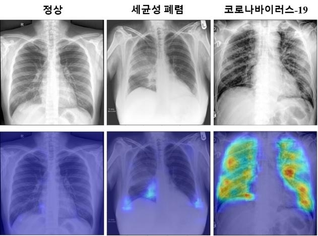 고화질로 코로나19가 의심이 되는 부분이 표시되는 모습을 볼 수 있다. [제공=한국과학기술원(KAIST)